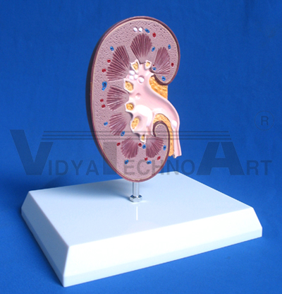 Concretion in ureter, major renal calices, minor renal calices and kidney